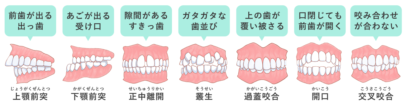 悪い歯並び