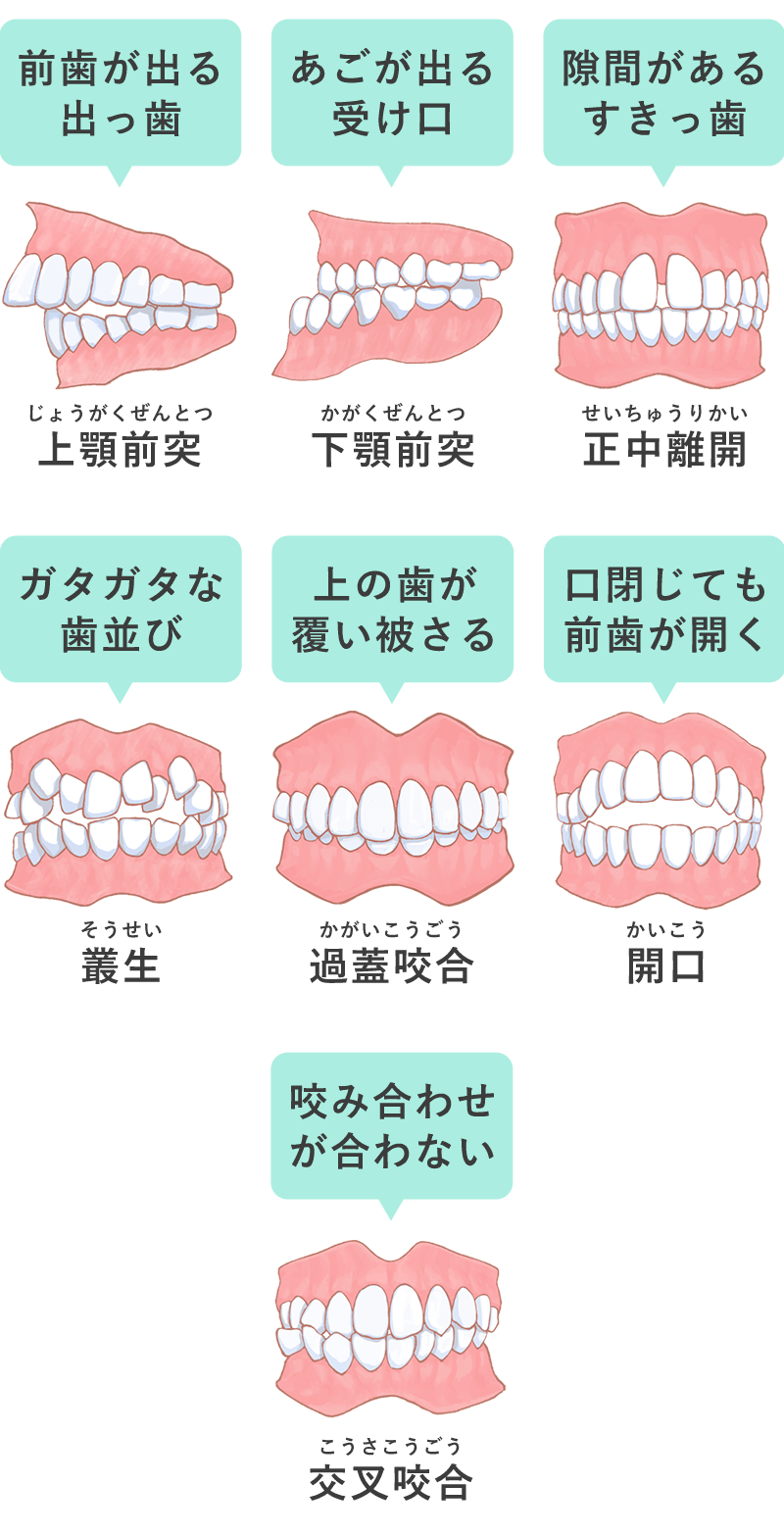 悪い歯並び