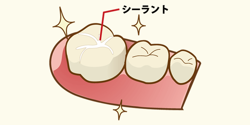 シーラント