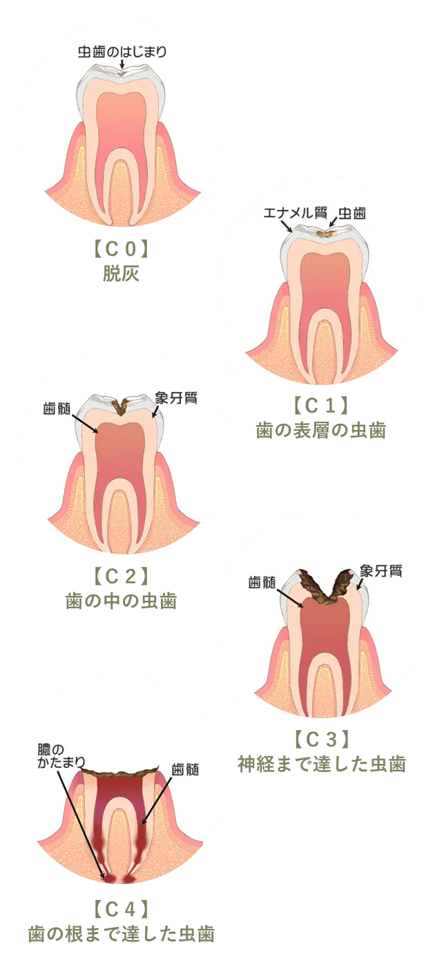 虫歯の進行