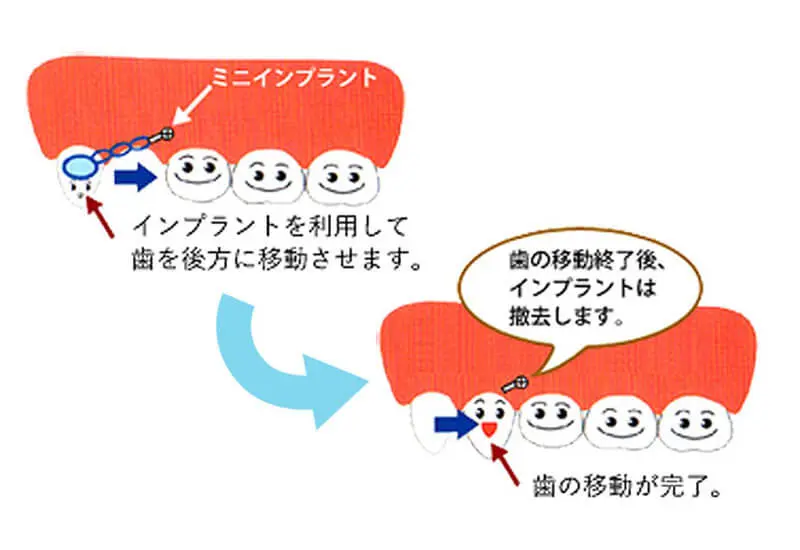 MTM部分矯正