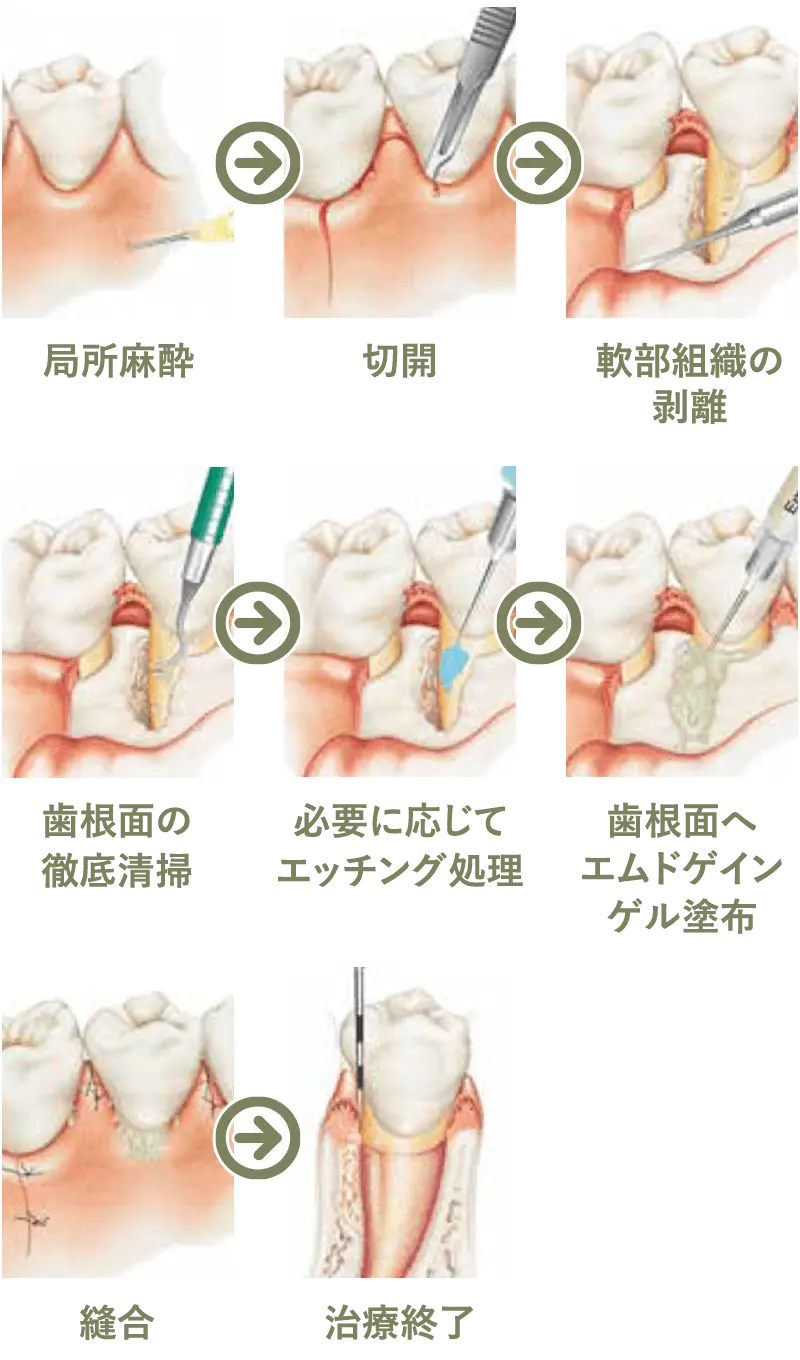 エムドゲインゲル